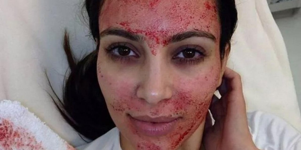 Kim Kardashian’ın Vampir Bakımından AIDS Bulaştı